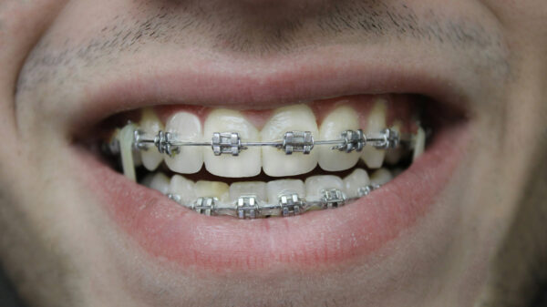aparat ortodontyczny