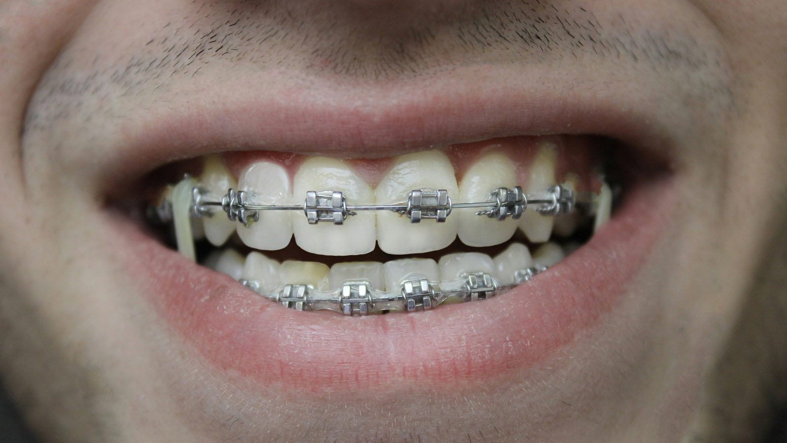 aparat ortodontyczny